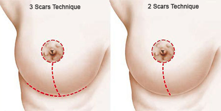 breast reduction surgery tunisia